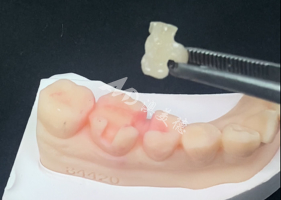 কেনা প্রাকৃতিক দাঁতের রঙ এবং সহজ রক্ষণাবেক্ষণের জন্য ইমেক্স সিরামিক ইনলেস অনলেস দাঁতের পুনরুদ্ধার online manufacture