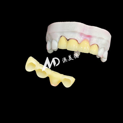 কেনা Premium Ceramic Crowns and Bridges for High-Strength, Natural Aesthetics and Long-Lasting Clinical Performance online manufacture