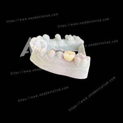 কেনা PFM মেরিল্যান্ড ব্রিজ: একটি পন্টিক, দুটি উইং - একটি রক্ষণশীল এবং নান্দনিক সমাধান online manufacture