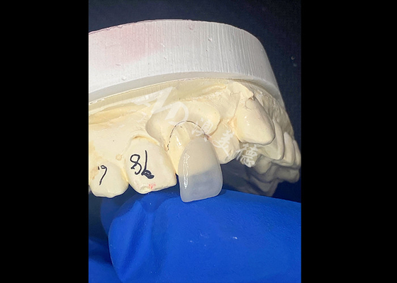 ভালো দাম আইপিএস ই.ম্যাক্স A1 ছায়ায় incisor জন্য veneers বিমূর্ত হাসি জন্য প্রাকৃতিক নান্দনিকতা অনলাইন